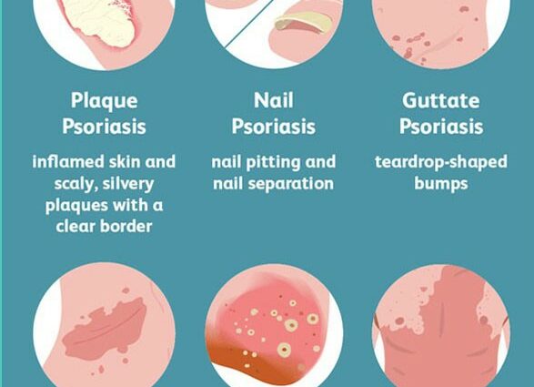 Medical treatments for psoriasis
