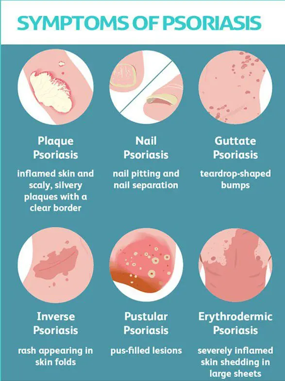 Medical treatments for psoriasis