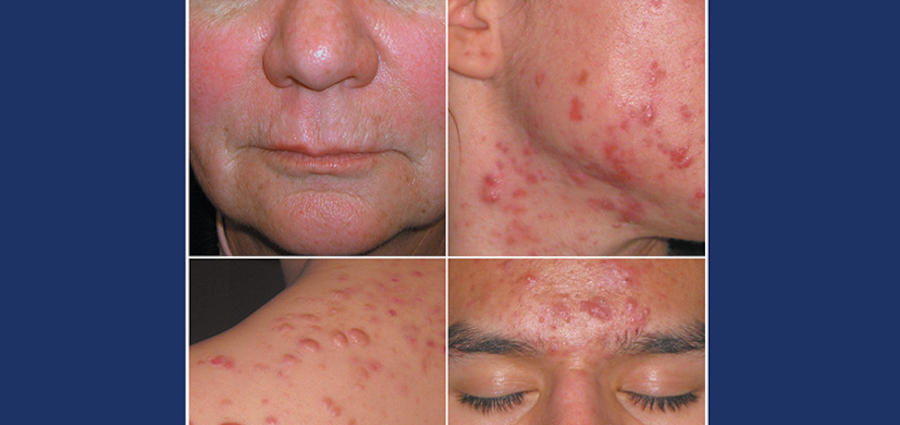 Medical treatments for rosacea