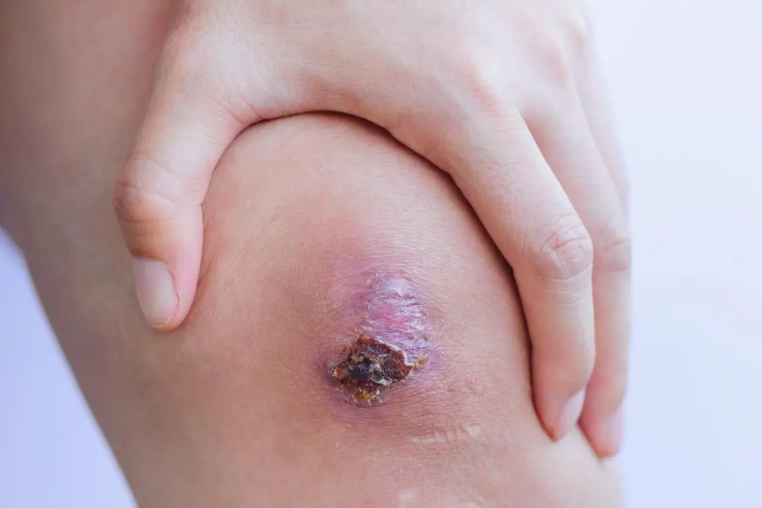 Medical treatments for scabs