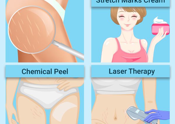 Medical treatments for stretch marks