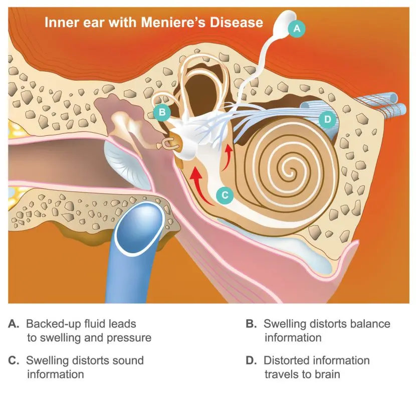 Ménière&#8217;s disease &#8211; Sites of interest