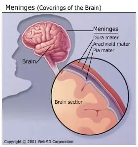 Meningitis