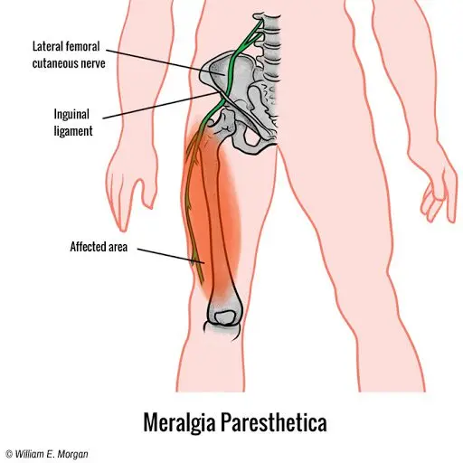 Meralgia