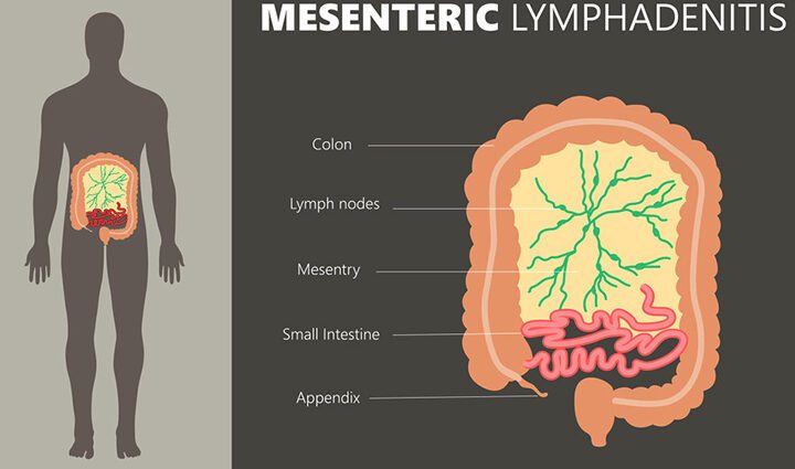 Mesenteric infection in children, treatment, symptoms