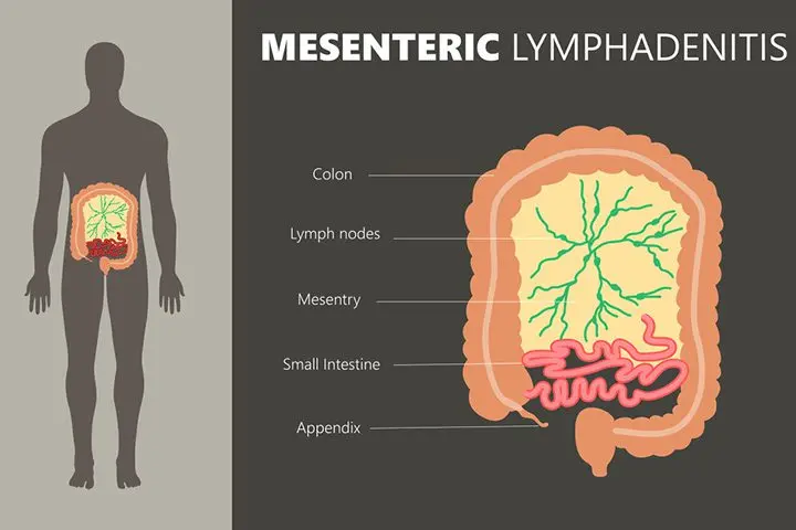 Mesenteric infection in children, treatment, symptoms