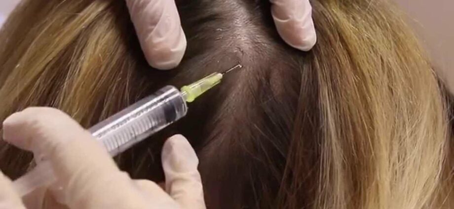 Mesotherapy for hair: reviews. Video