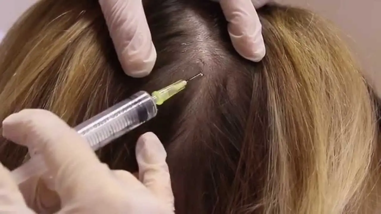 Mesotherapy for hair: reviews. Video