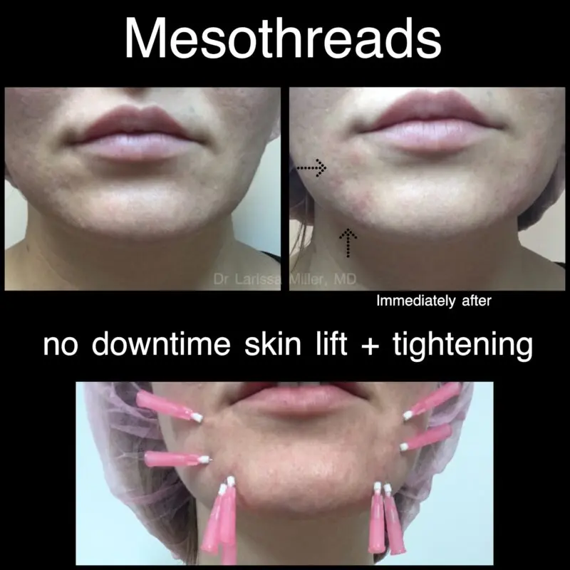 Mesothreads for the face: reviews