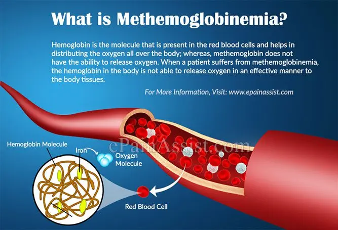 Methemoglobin: definition, causes and treatments