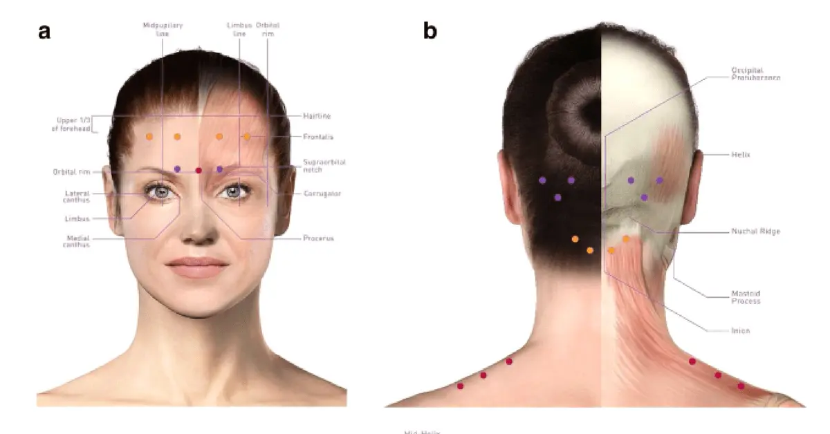 Migraine &#8211; Sites of interest