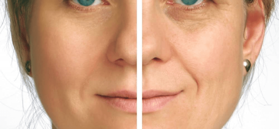 Mini kasvojenkohotus: mitä eroja on kasvojenkohotuksessa?