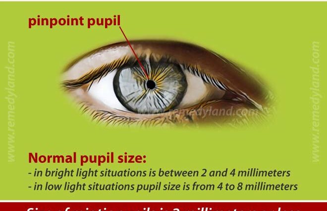 Miosis: definition, causes and treatments