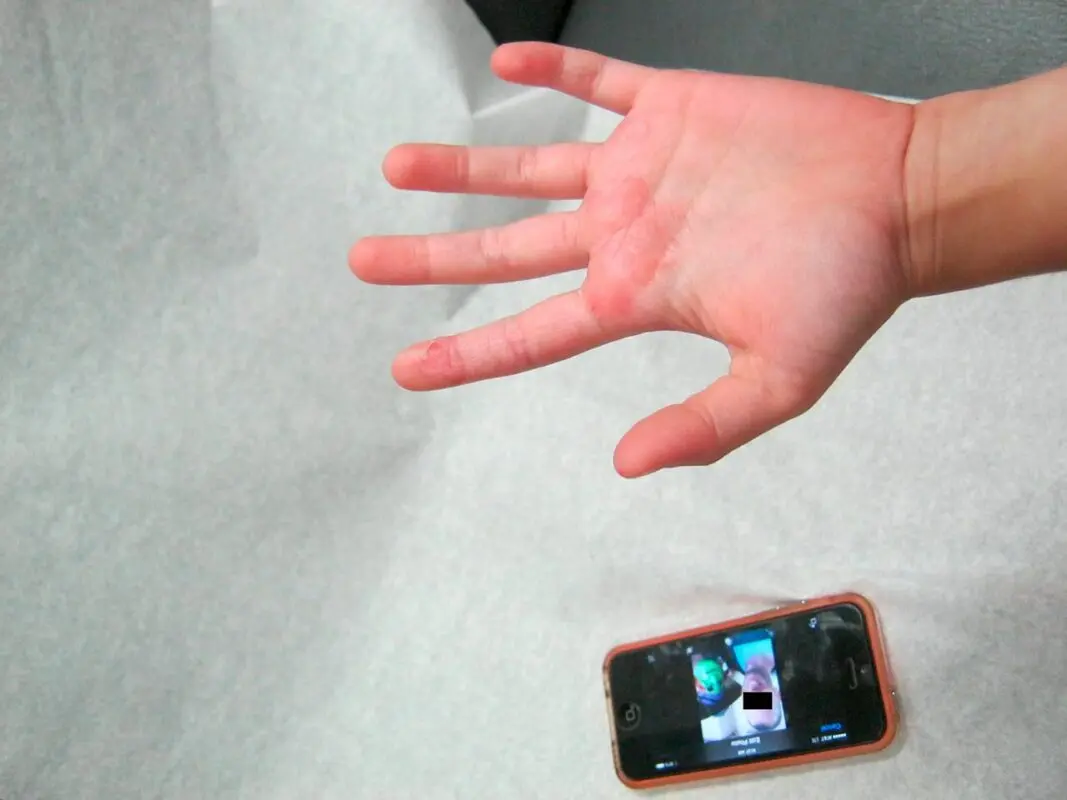 Mobile phone use leads to dermatitis