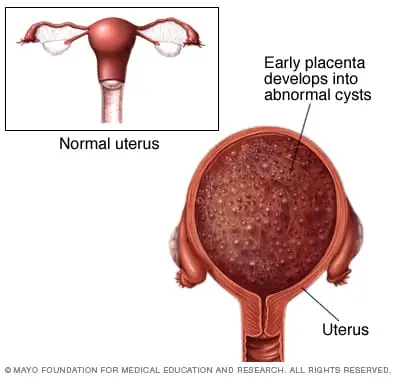 Molar pregnancy