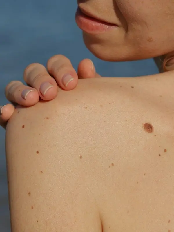 Mole removal: what you need to know? Video