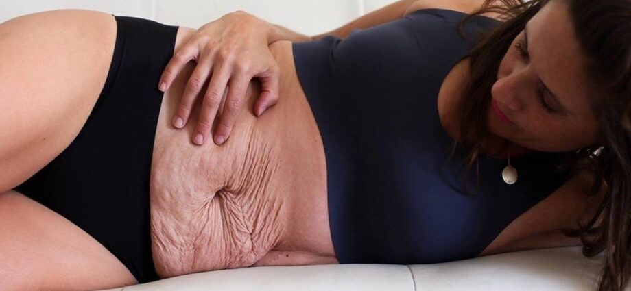 Mom showed body after cesarean and became an Instagram sensation