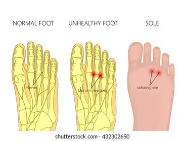 Morton&#8217;s Neuroma &#8211; Landmarks