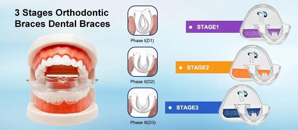 Mouth guards for aligning teeth: reviews. Video