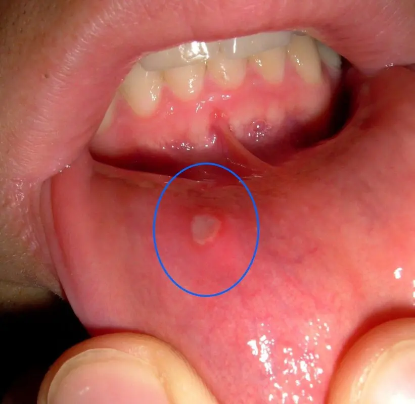 Mouth ulcers