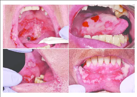 Mucitis: deciphering this inflammation of the mucous membrane