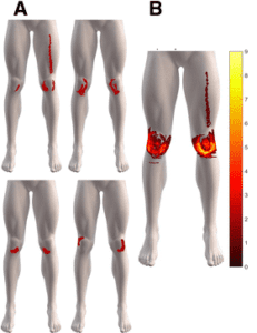 Mišićno -koštani poremećaji koljena