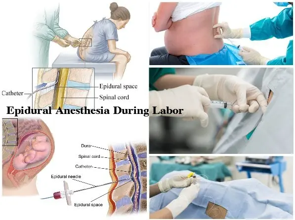 &#8220;My husband forbids me to do epidural anesthesia during labor.&#8221;