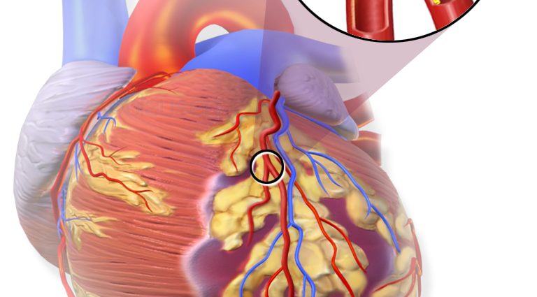 Miyokard Enfarktüsü: Nedir?