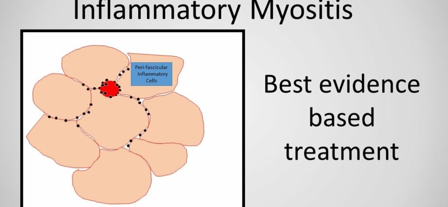 Myositis: treatment of the disease. Video