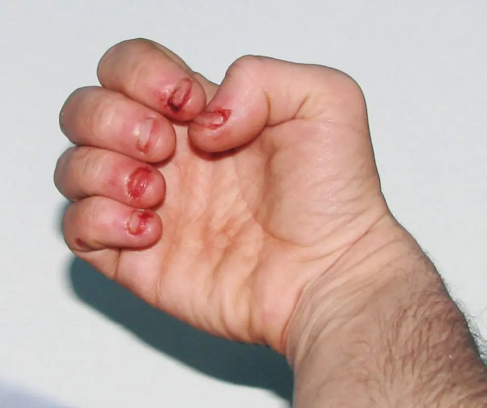 Nail biting: this happens to your body every time you do it