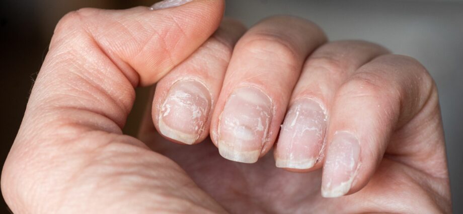 Nails break and exfoliate: what to do