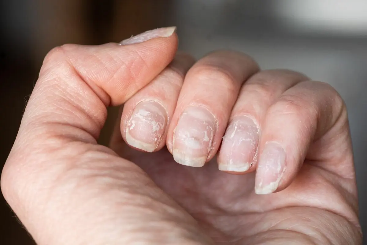 Nails break and exfoliate: what to do