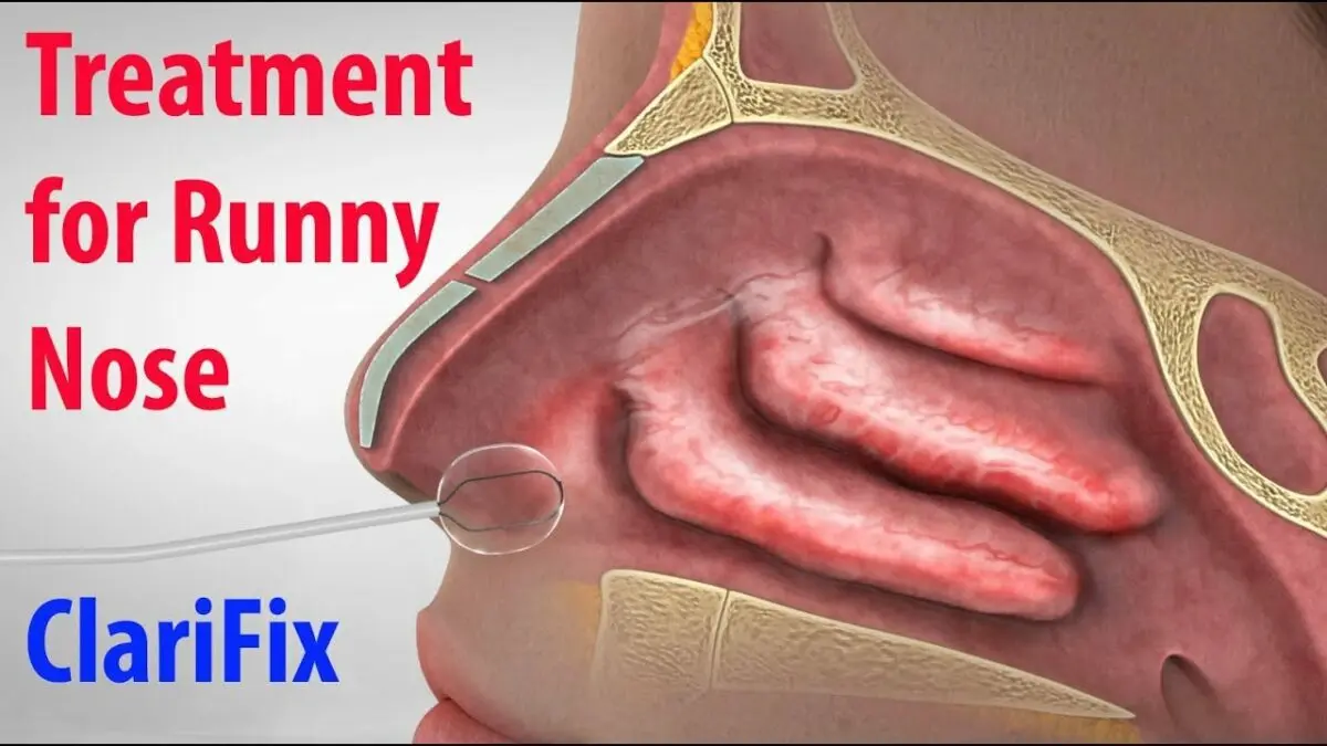 Nasal congestion: how is it treated? Video