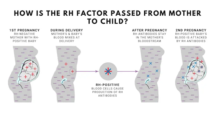 Negative Rh factor in pregnancy, in the second pregnancy