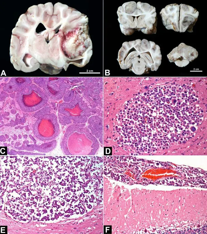 Neoplasia: pulmonary or mammary, what is it?