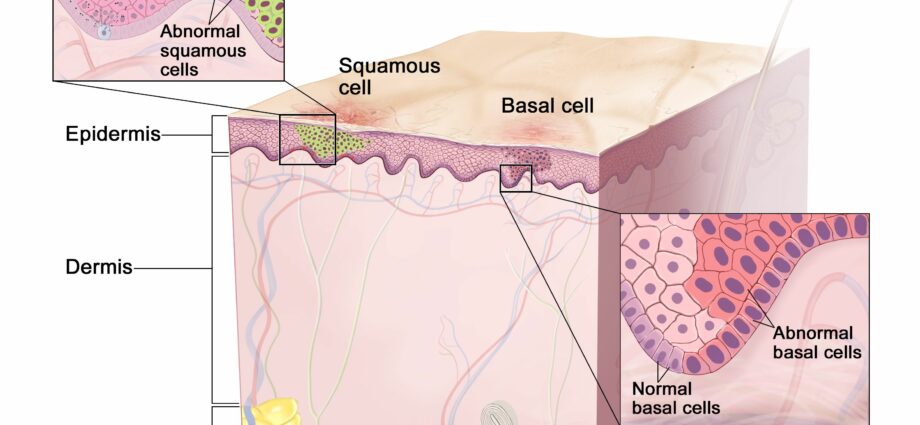 Neoplasms of the skin and subcutaneous tissue