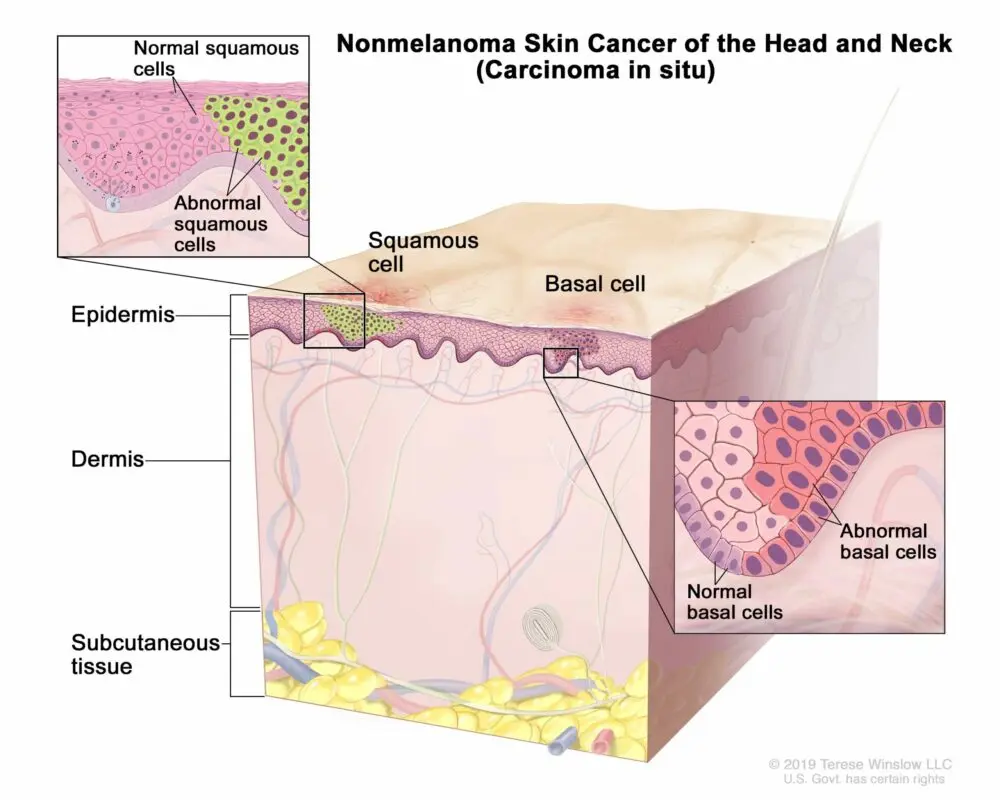 Neoplasms of the skin and subcutaneous tissue