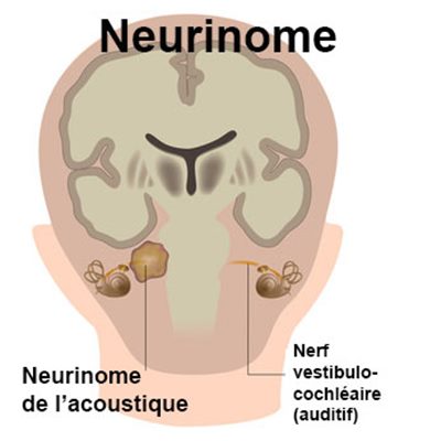 Neurinoma