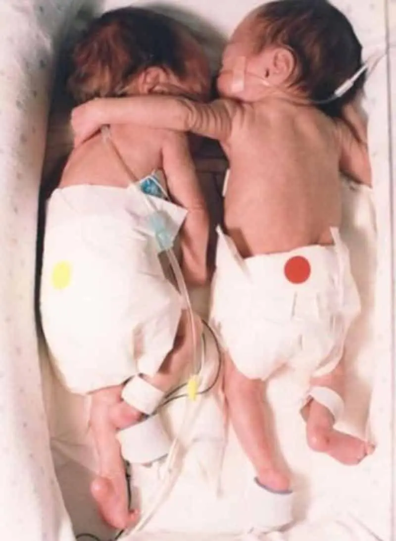 Newborn girl rescued her twin sister