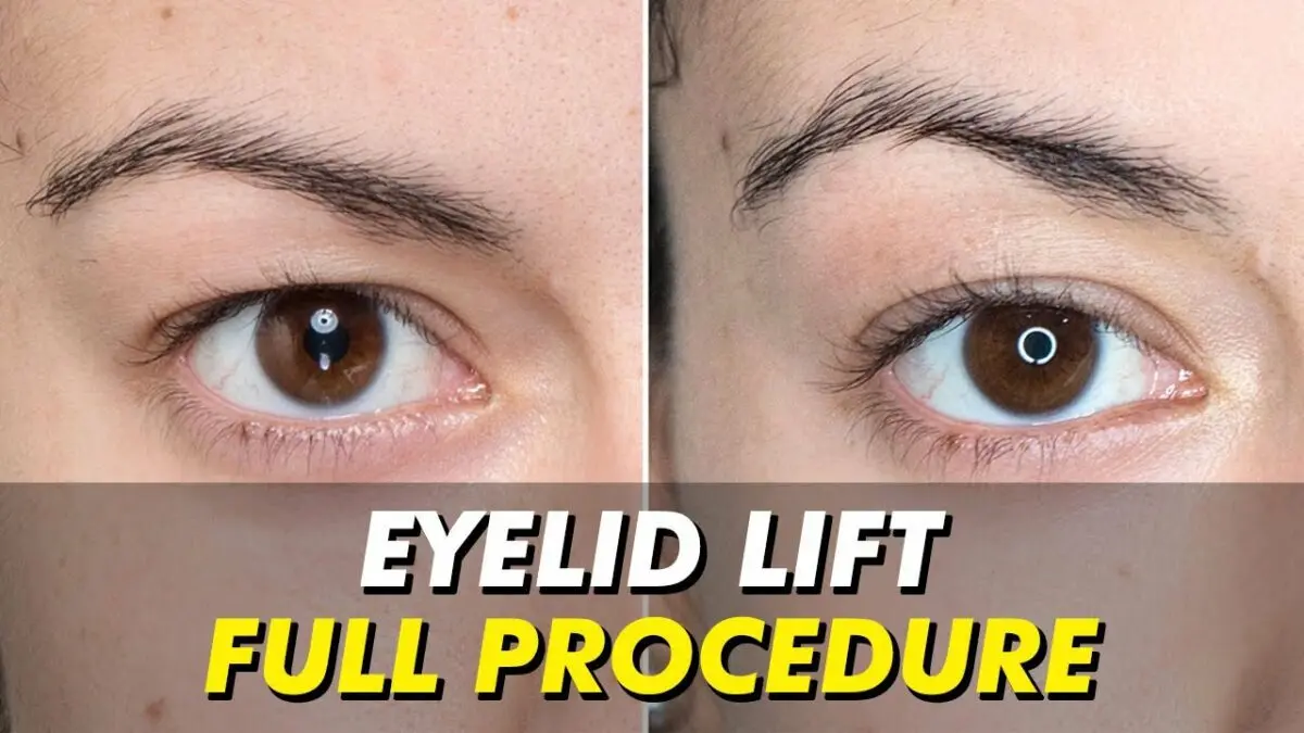 Non-surgical eyelid lift. Video reviews