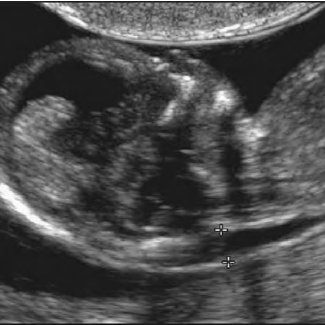 Nuchal translucency: detecting trisomy 21