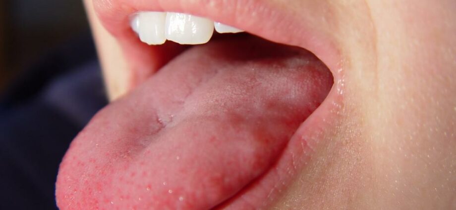 Numbness of the tongue: causes