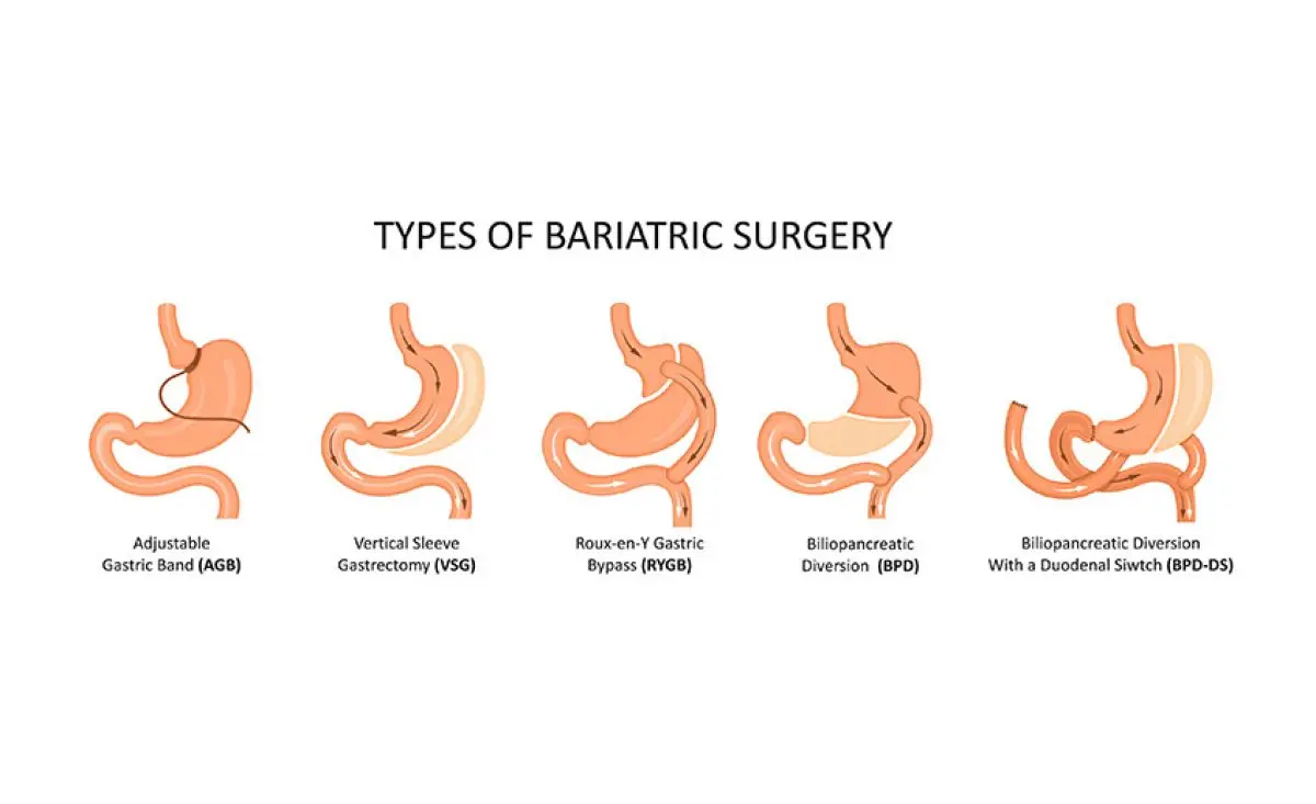 Obesity surgery types of bariatric surgeries