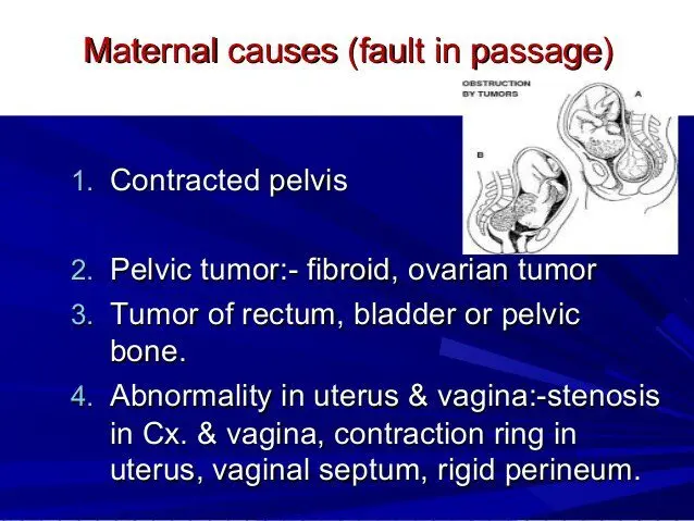 Obstructed labor: what is shoulder dystocia?