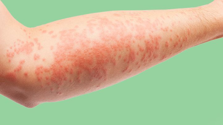 Ocher dermatitis: definition, causes and treatments