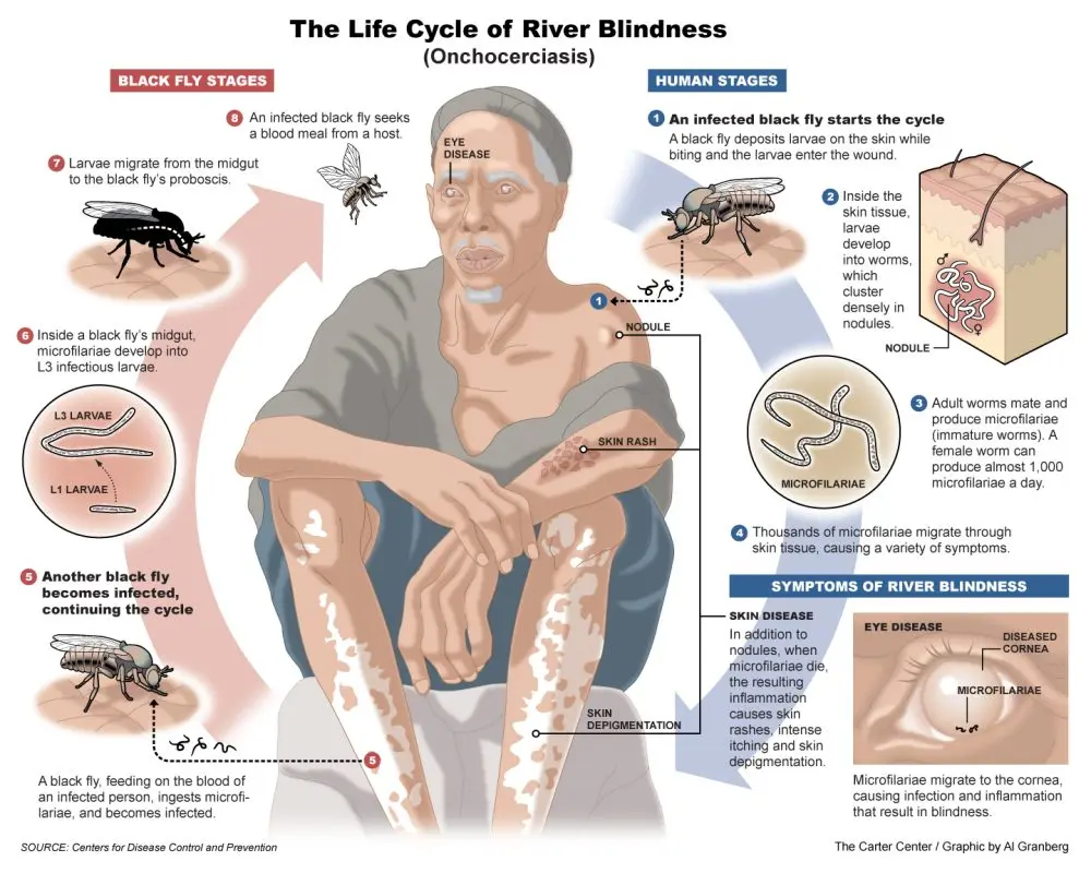 Onchocerciasis: definition, causes and prevention