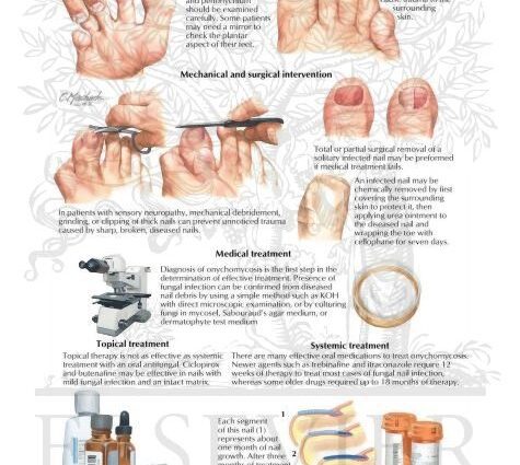 Onychomycosis: prevention