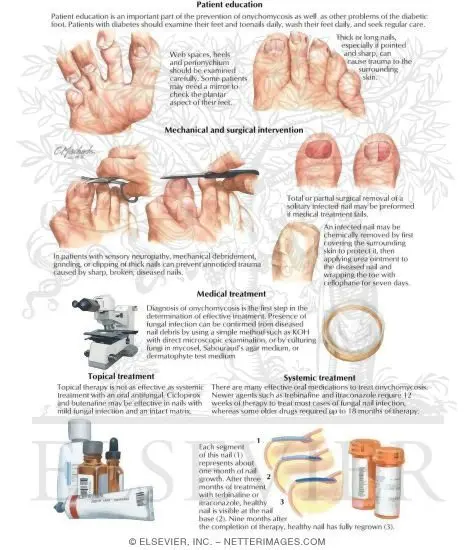 Onychomycosis: prevention