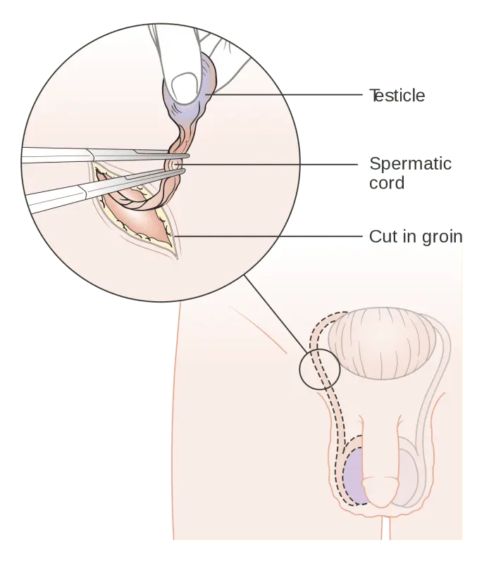 Orchidectomie