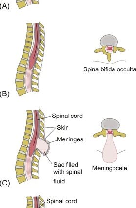 Origins and types of spina bifida – Healthy Food Near Me